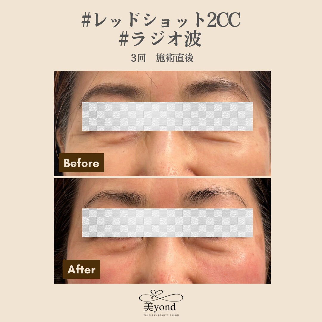 施術Before/After📷