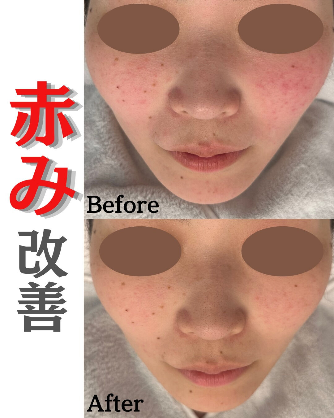【乳酸菌ピーリング Before/After】