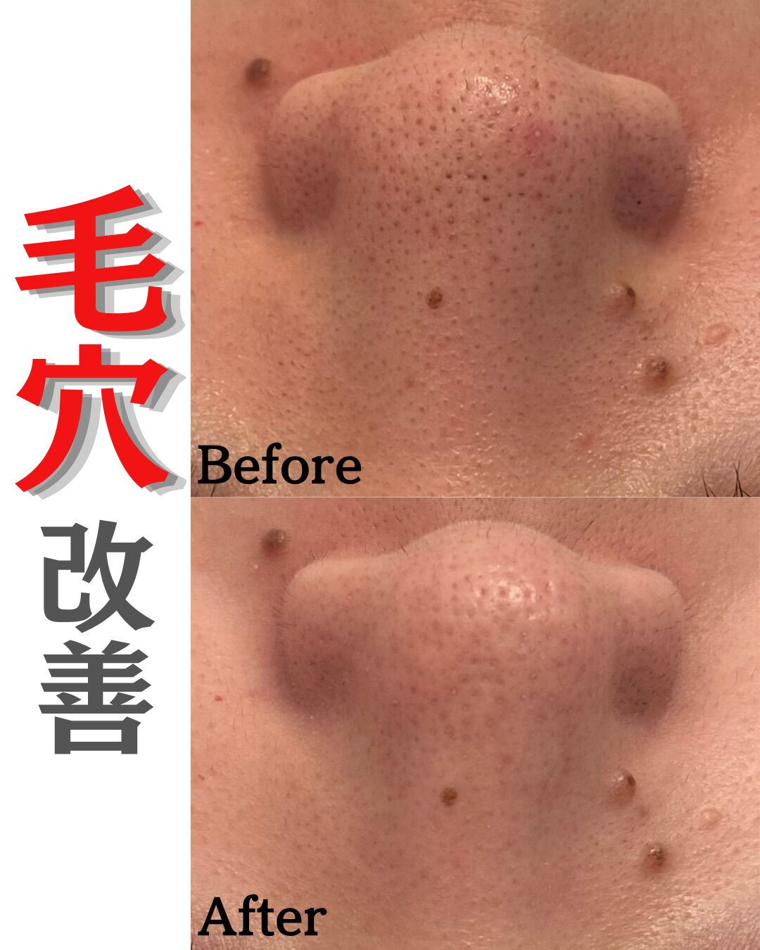 【毛穴改善16回Before/After】