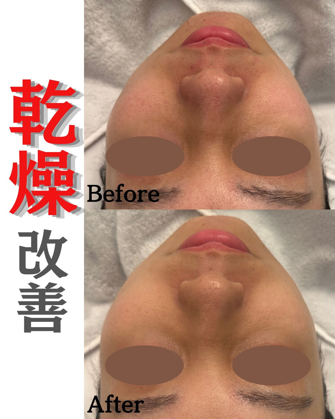 【ハーブピーリング5回 Before/After】