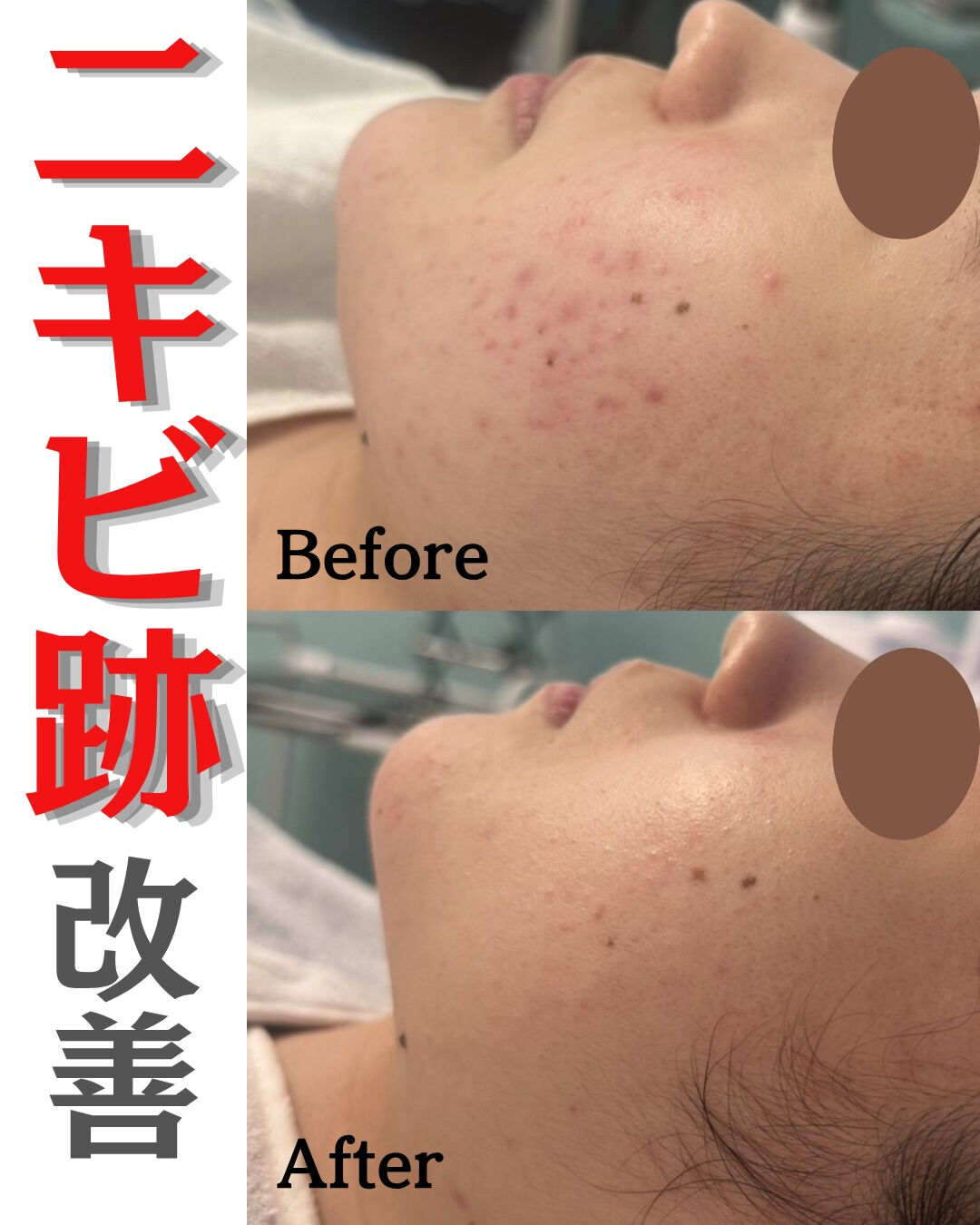 【ハーブピーリング（剥離あり）Before/After】