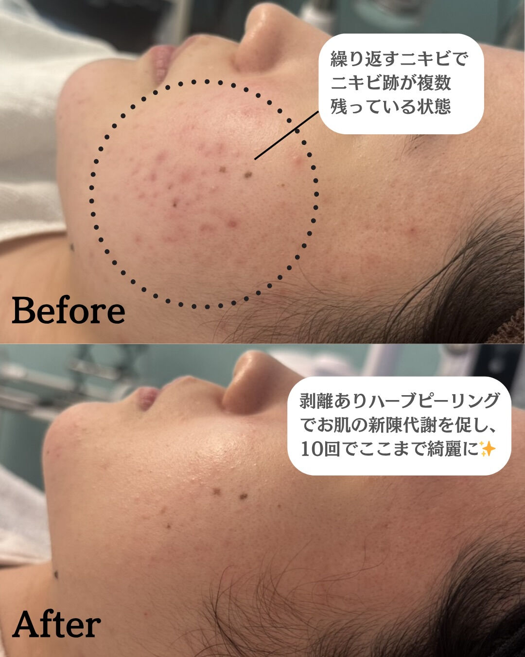 【ハーブピーリング（剥離あり）Before/After】