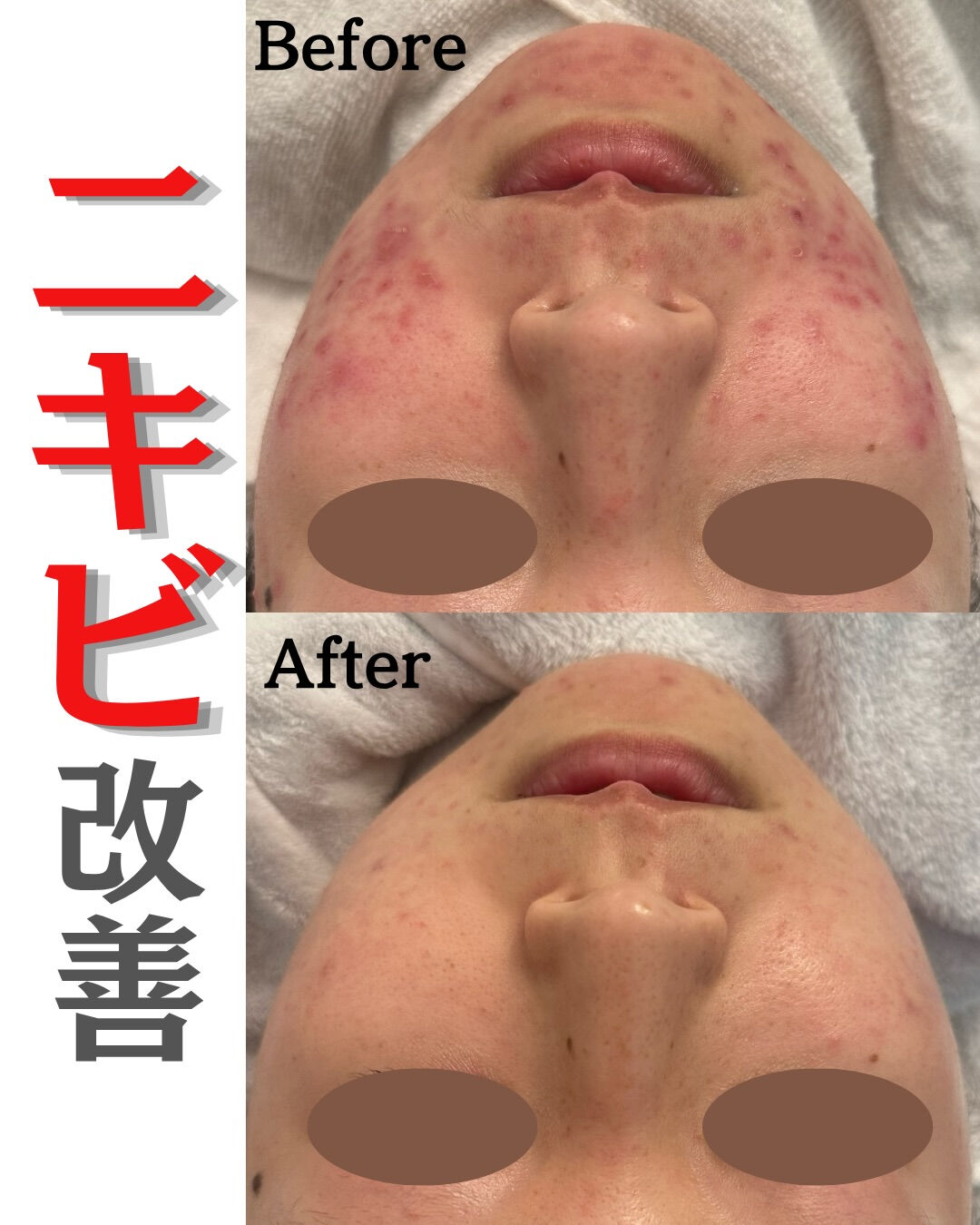 【ハーブピーリング🌱Before/After】
