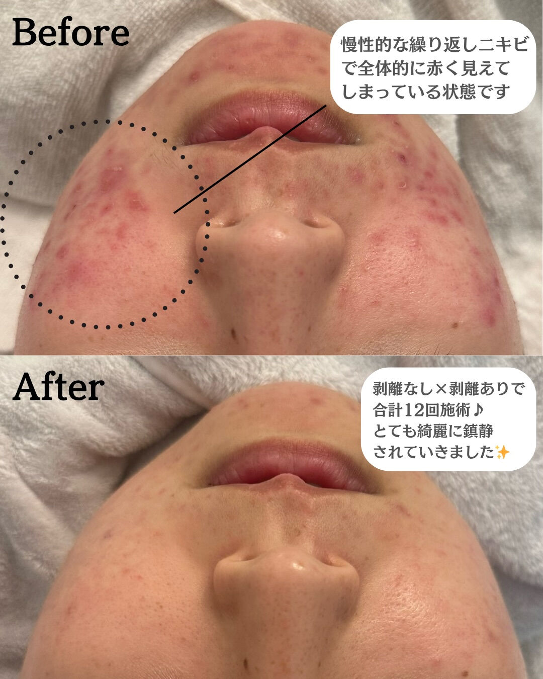【ハーブピーリング🌱Before/After】
