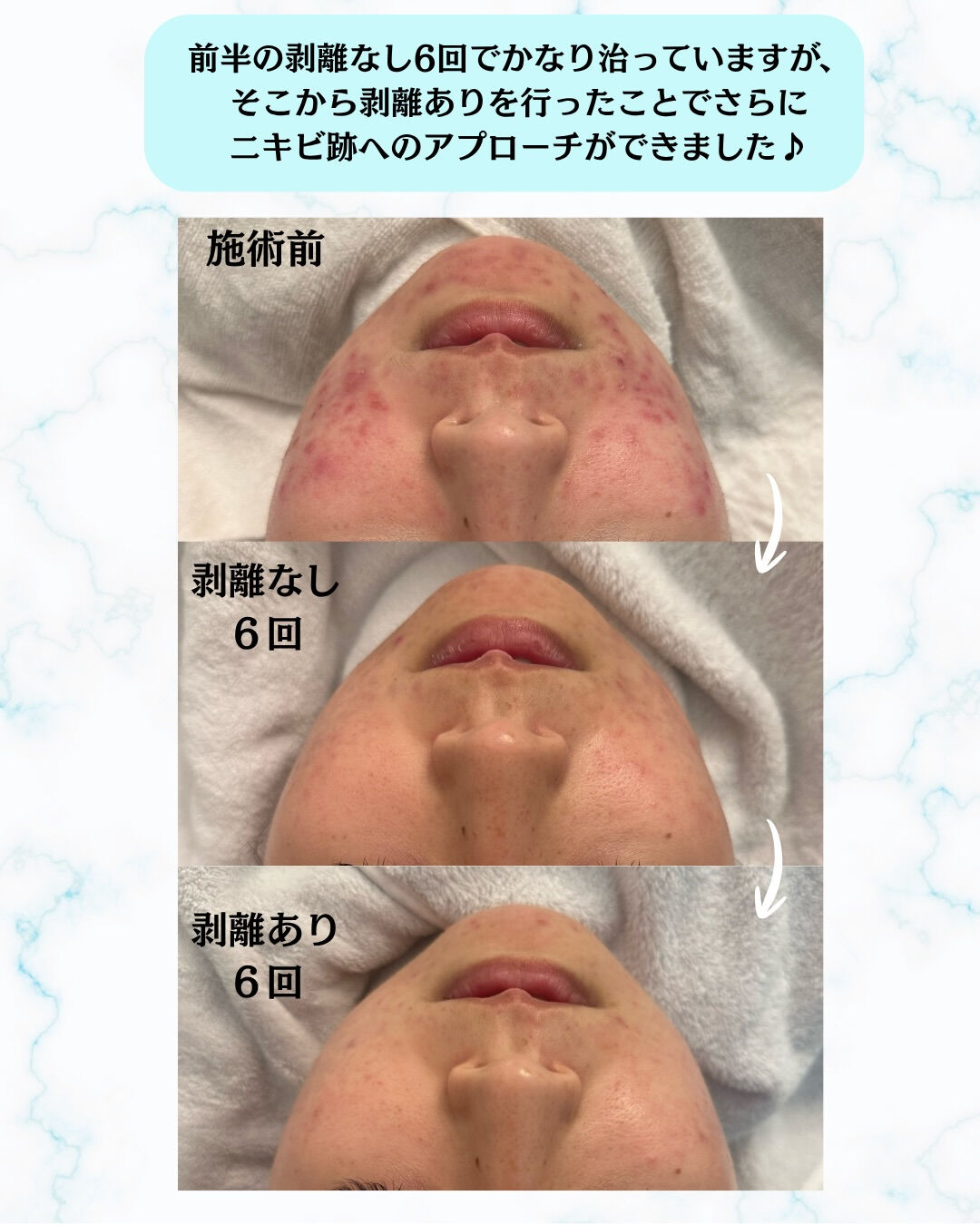 【ハーブピーリング🌱Before/After】