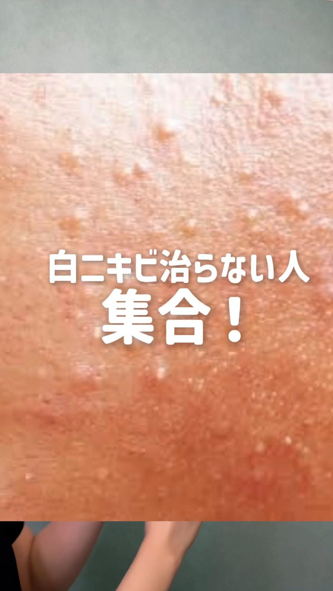 白ニキビ「軽いから」「そのうち治るから」と放置していませんか