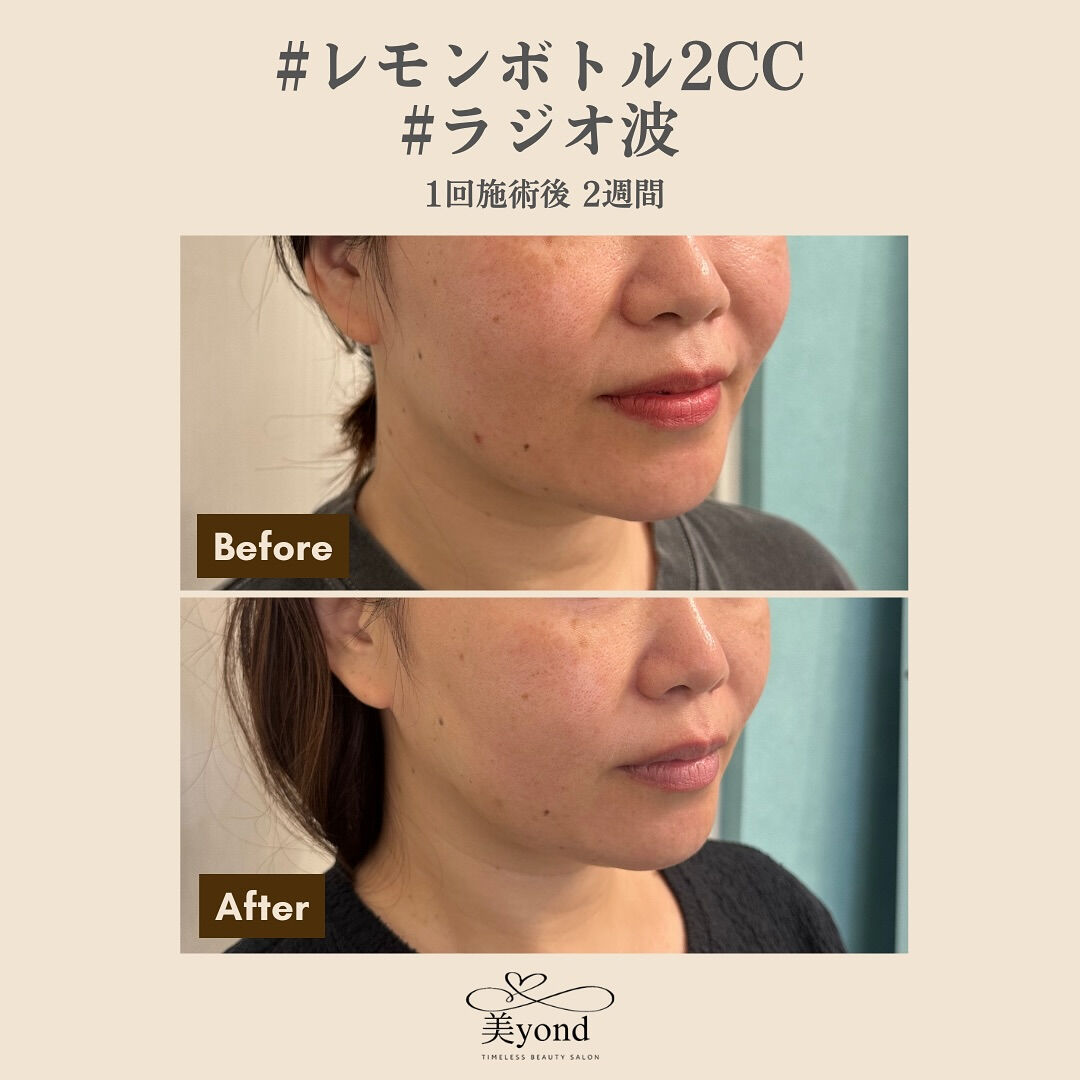施術Before/After📷