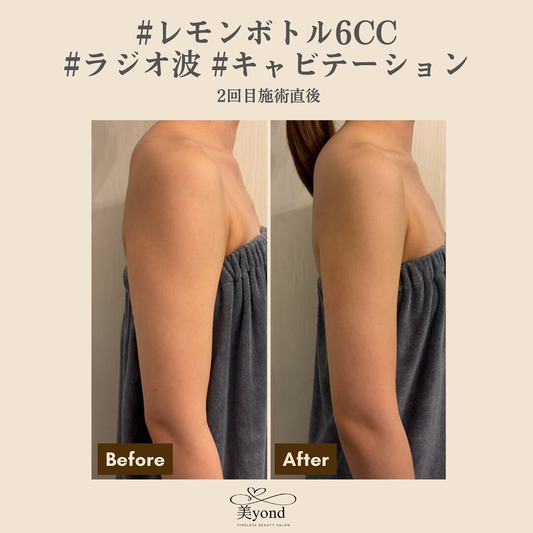 施術Before/After📷