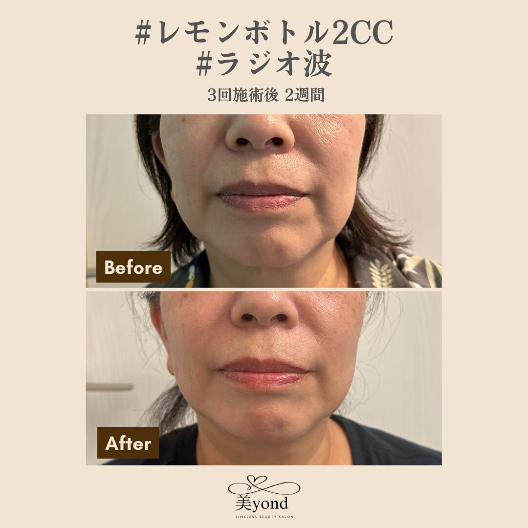 施術Before/After📷