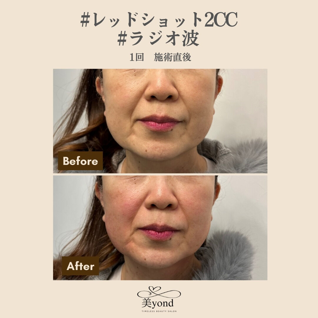 施術Before/After📷